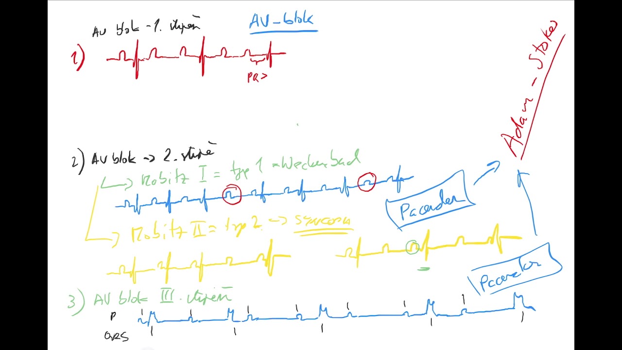 EKG 5 by Coiled CZECH (AV bloky, Mobitz, Wenckebach, blok levého (LBBB) a pravého Tawarova raménka)