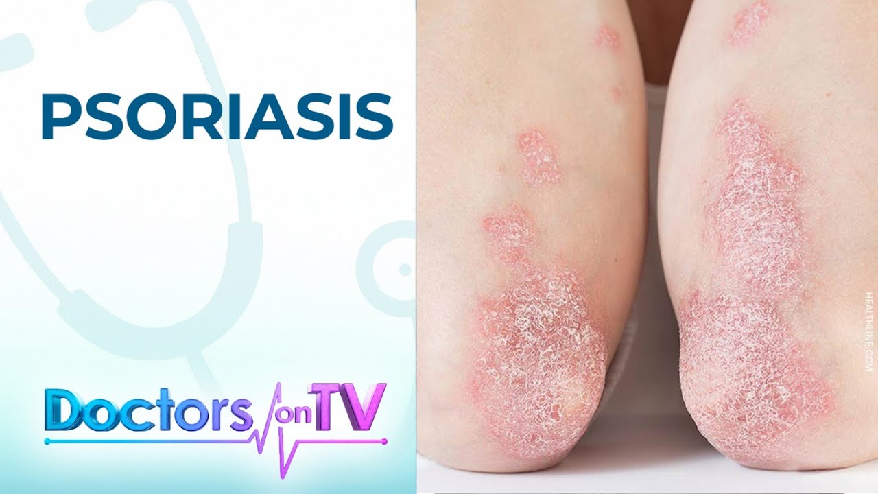 What you can do about psoriasis | DOTV