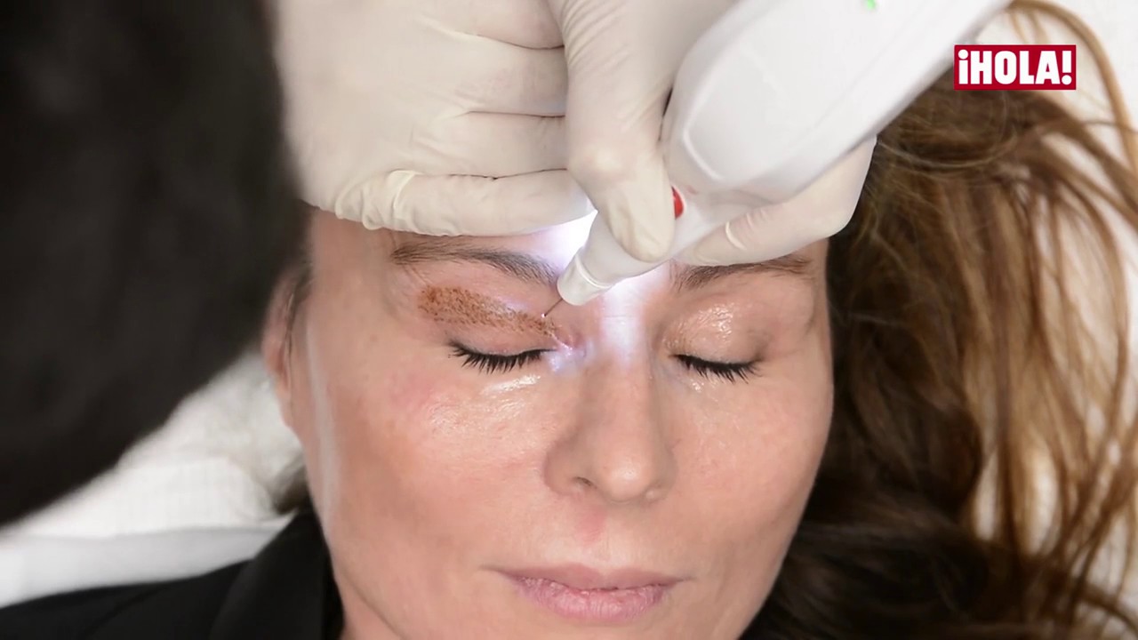Plexr®: LA NUEVA BLEFAROPLASTIA SIN CIRUGÍA. El arte de la estética