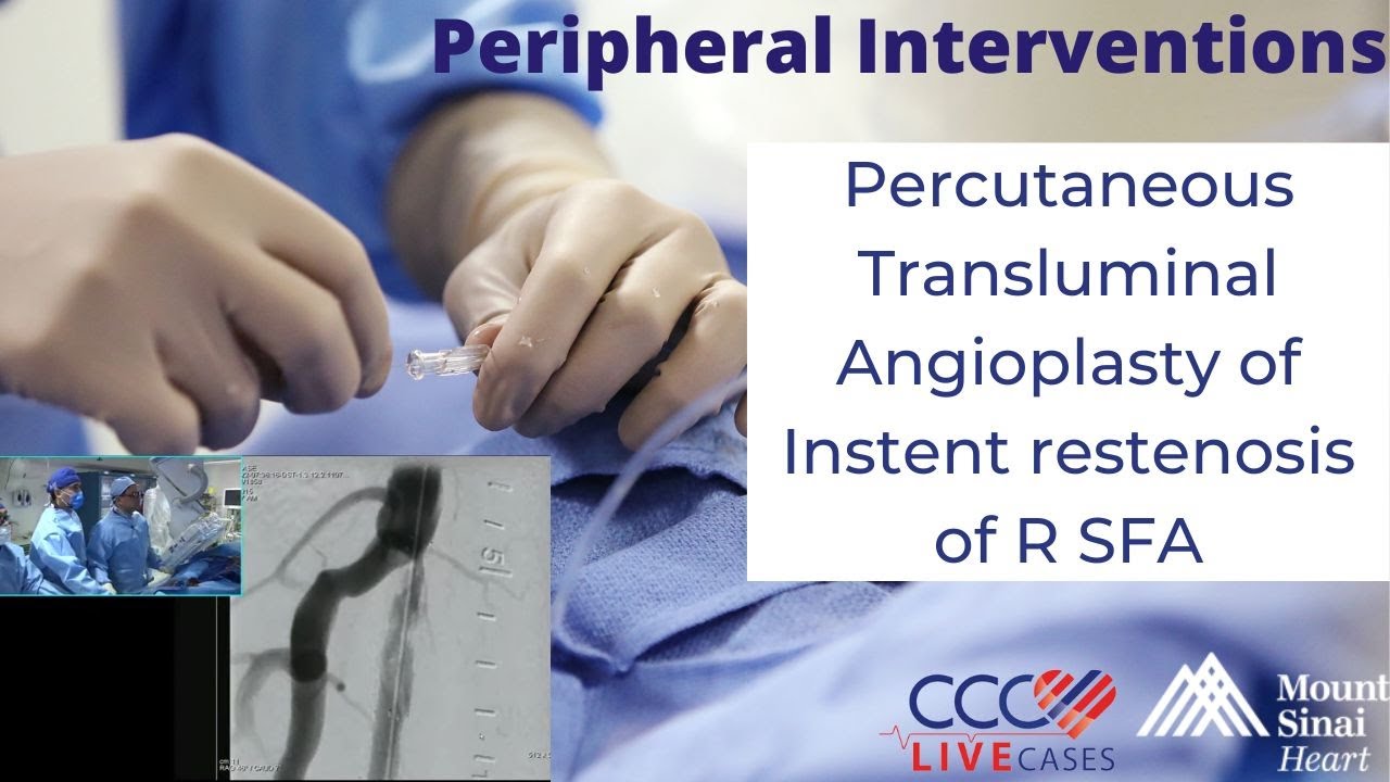 Percutaneous Transluminal Angioplasty of Instent restenosis of R SFA - July 22, 2015 Live Case Video
