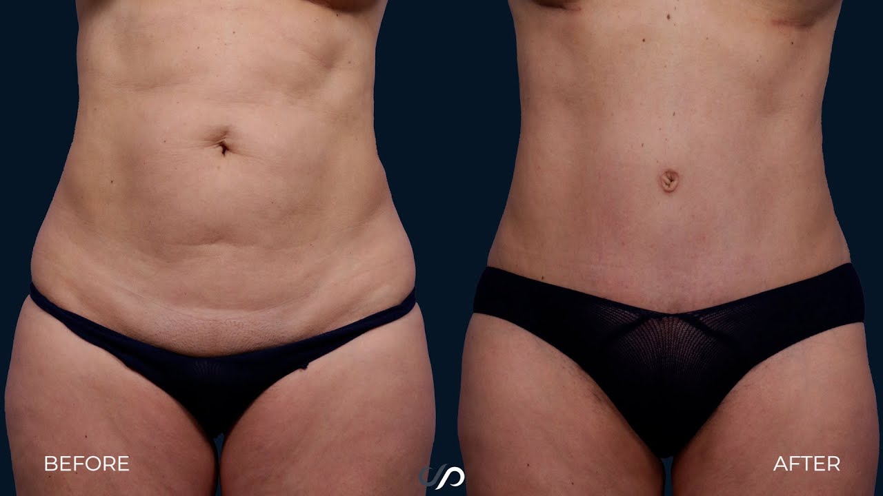 Female Body Rejuvenation | Before and After | Dr. David Stoker
