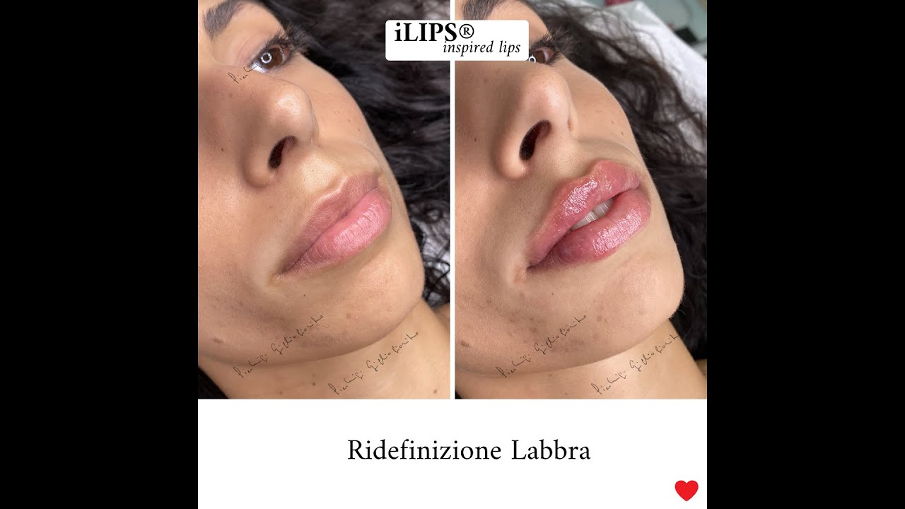 iLips®: filler labbra con Belotero Intense by Dr. Pierluigi Gigliofiorito