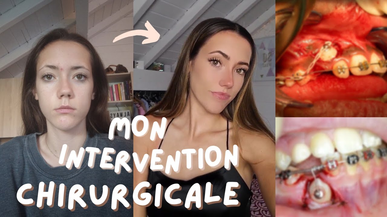 MON INTERVENTION CHIRURGICALE DES GENCIVES