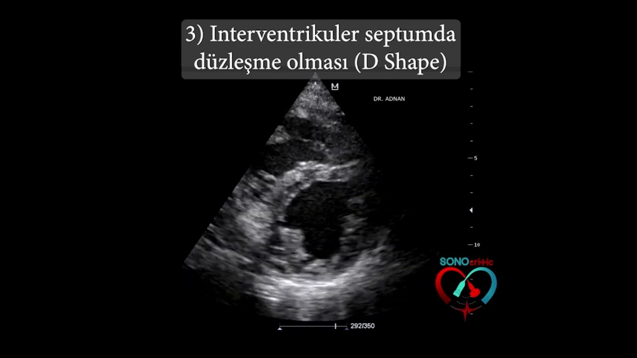Pulmoner Emboli Ekokardiyografi Bulguları