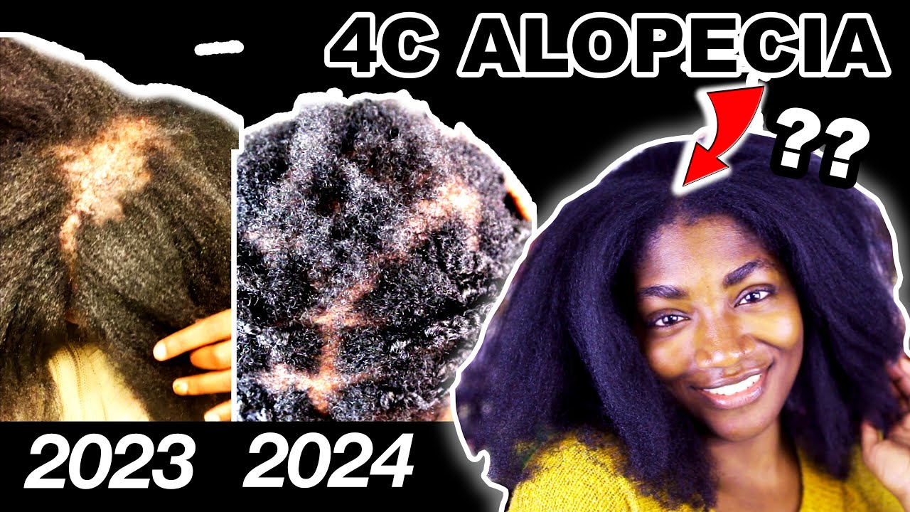 I ignored my 4C natural hair for a YEAR. Here's what happened. (Alopecia Journey)
