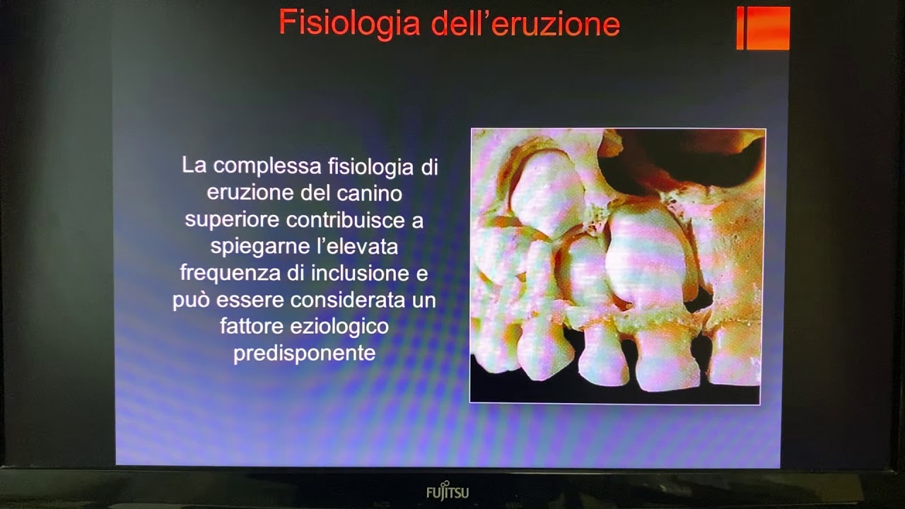 Canini inclusi:parte1