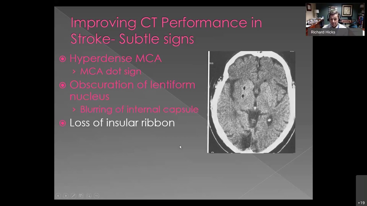 Stroke: The Role of CT and MRI in Diagnosis and Treatment
