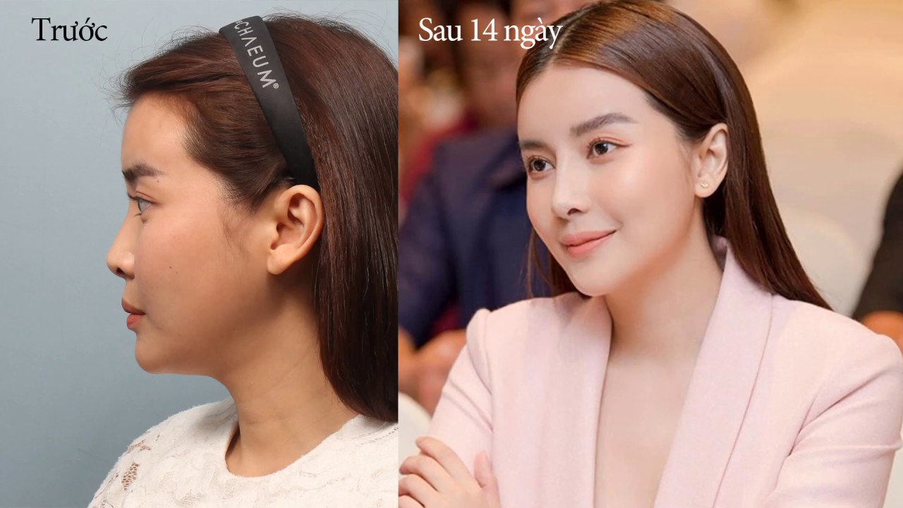 Cao Th&aacute;i H&agrave; phẫu thuật thẩm mỹ tại Banobagi