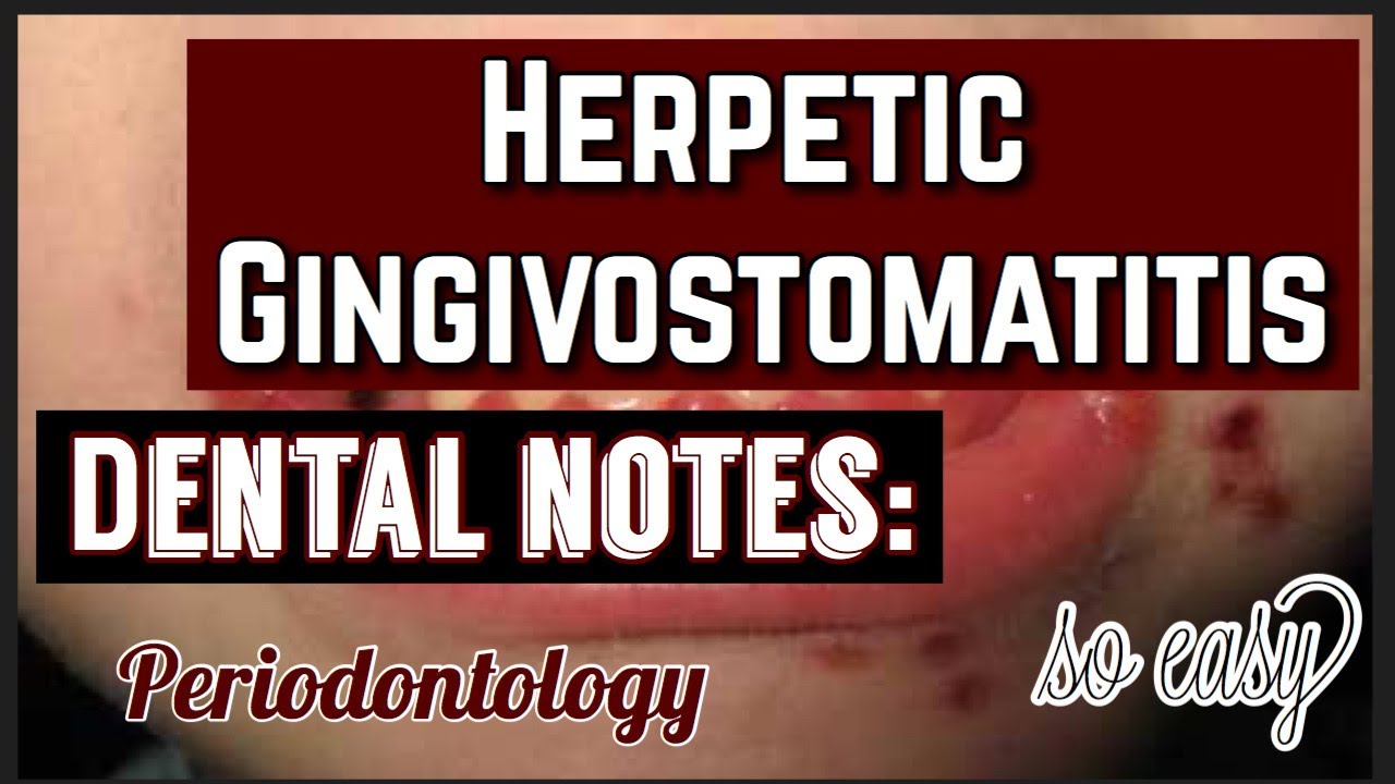 HERPETIC GINGIVOSTOMATITIS II PERIODONTOLOGY II ORAL PATHOLOGY II DENTAL NOTES II MADE EASY
