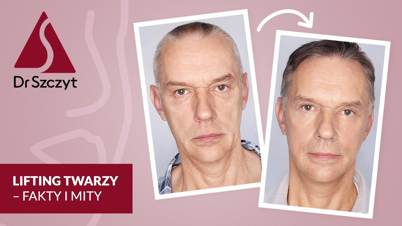 Lifting twarzy - fakty i mity