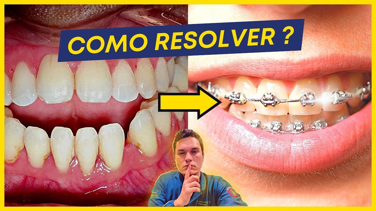 QUAL APARELHO CORRIGE A MORDIDA ABERTA?