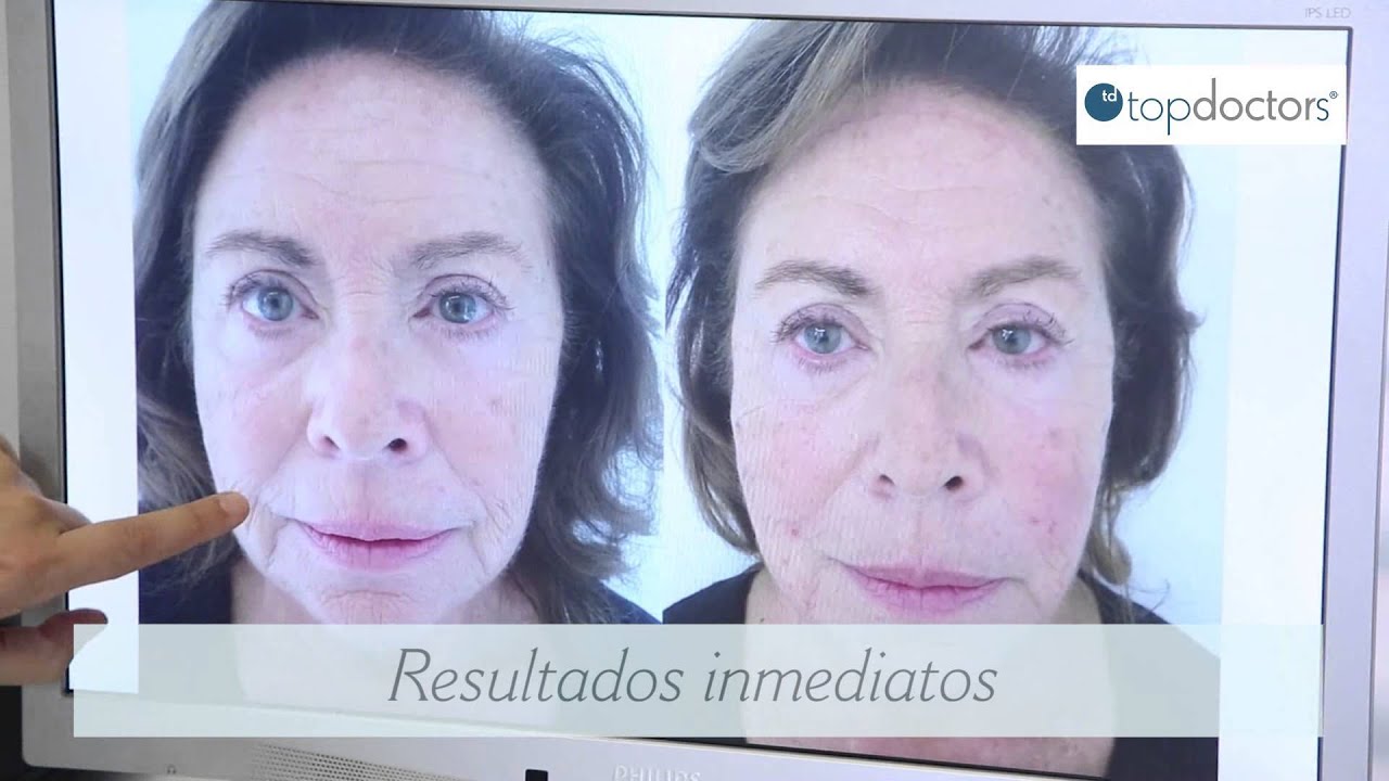 Hilos tensores para el tratamiento facial