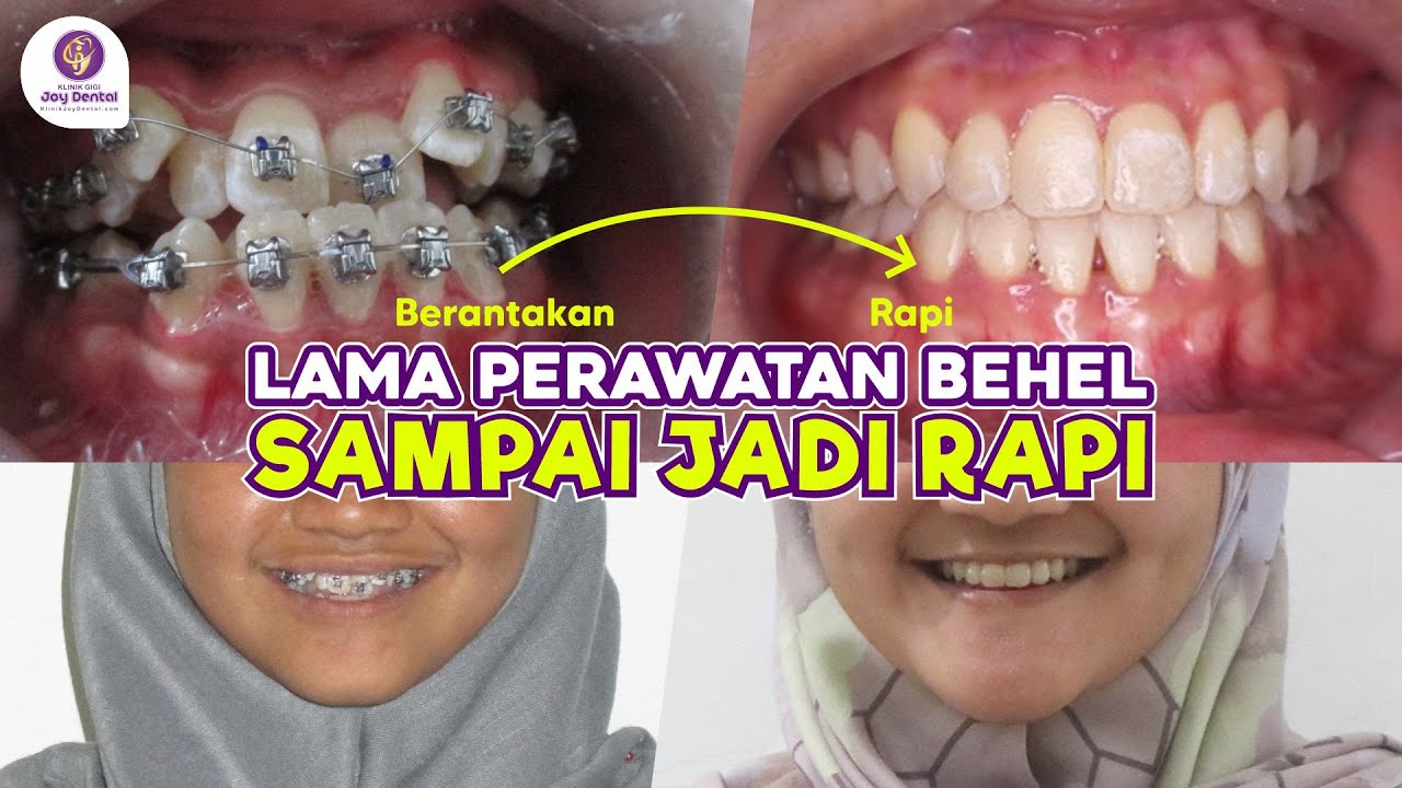 BERAPA LAMA MERAPIKAN GIGI DENGAN BEHEL ?