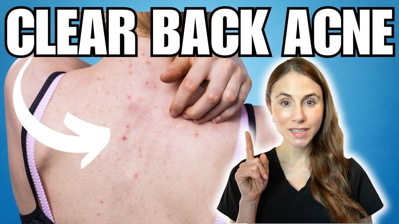 Clearing Back Acne: Expert Tips And Tricks