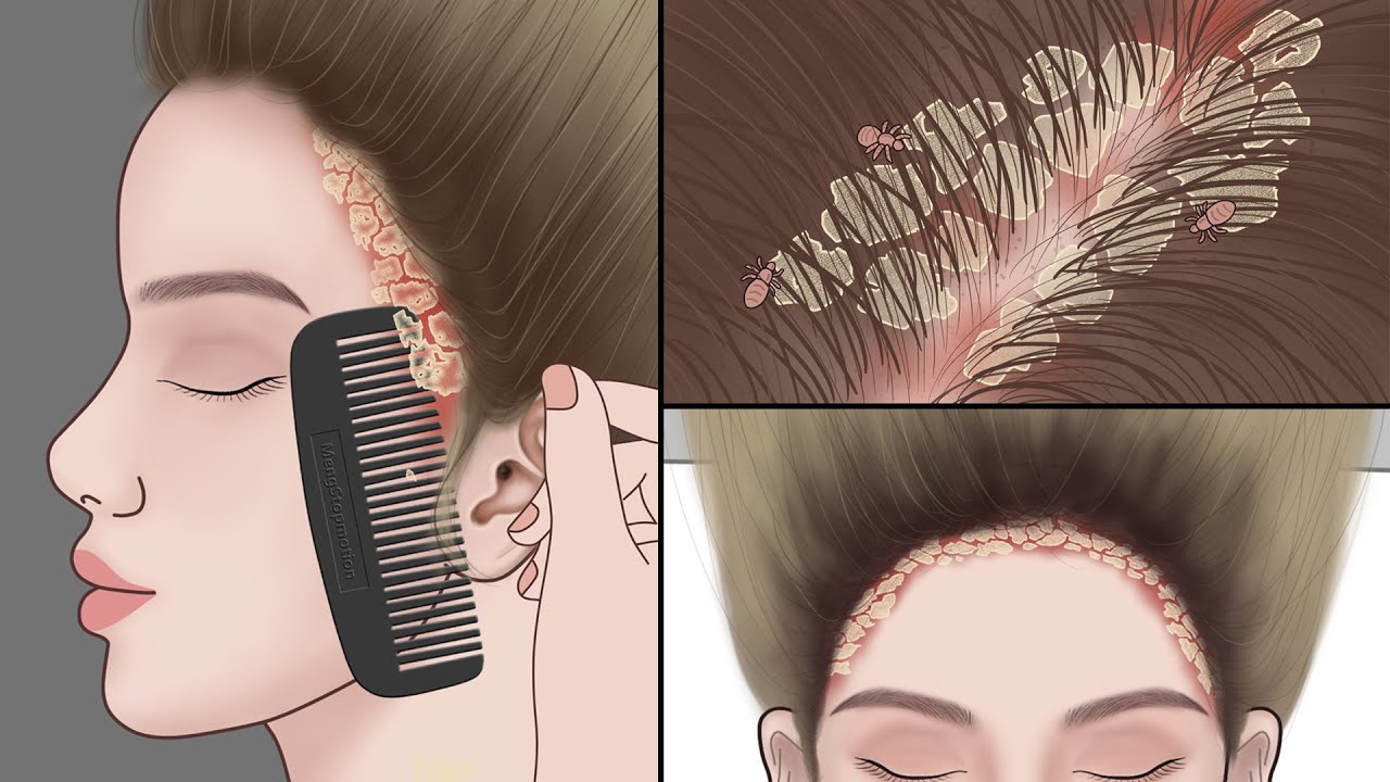 ASMR Animation | Satisfying Scalp Treatment | Big Flakes Dandruff Removal! | Meng&rsquo;s Stop Motion