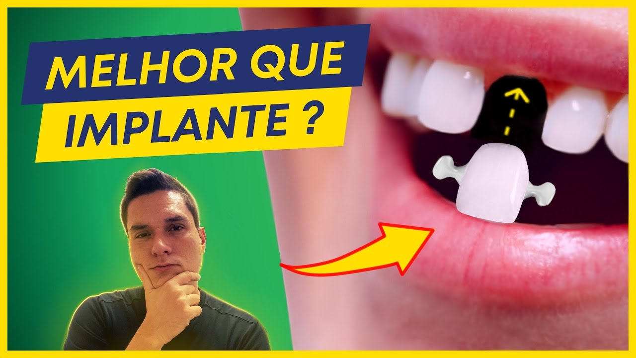 PRÓTESE FIXA ADESIVA VALE A PENA MESMO? VERDADE REVELADA.