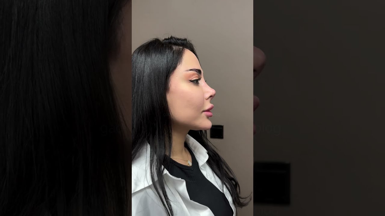 Barbie Nose Surgery: Achieve a Delicate, Refined Nasal Look