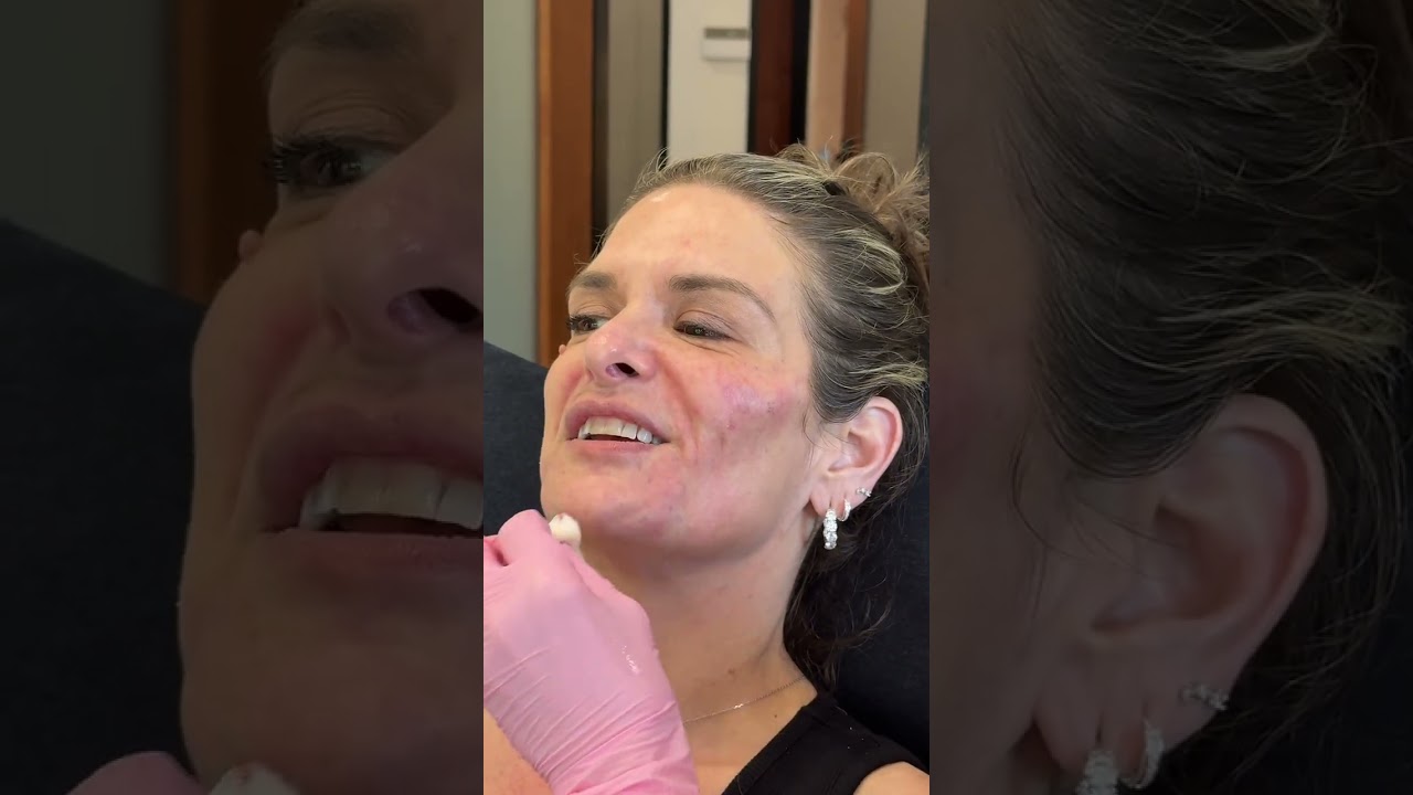 Full Face Filler Transformation After Major Weight Loss