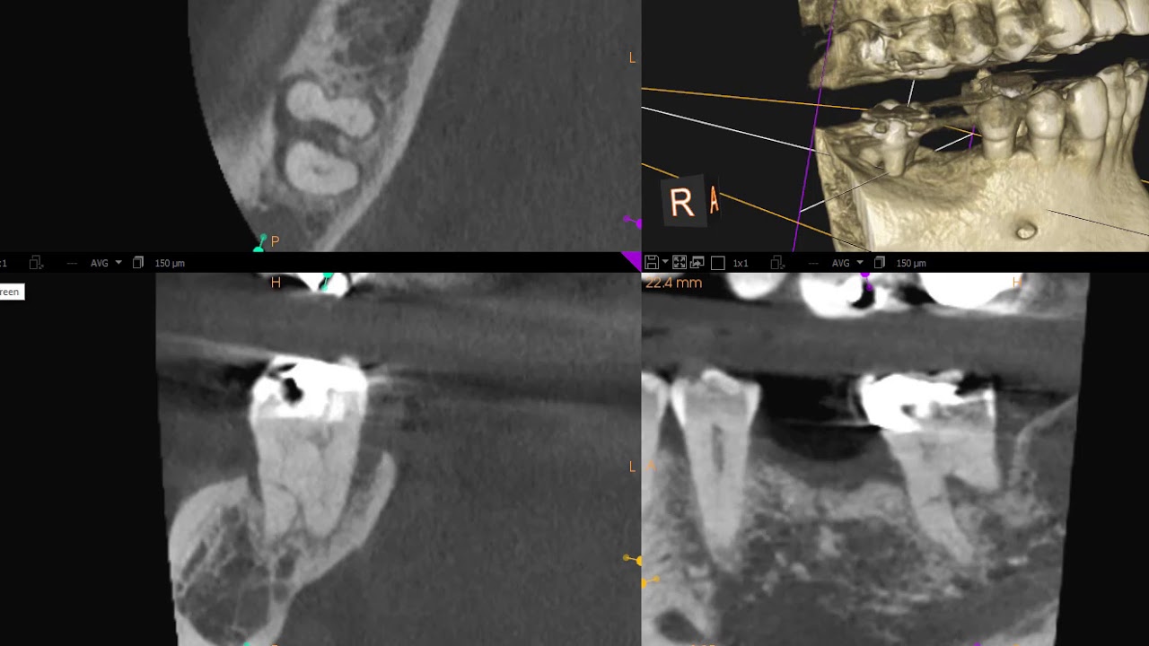 judy's tooth # 31 CBCT