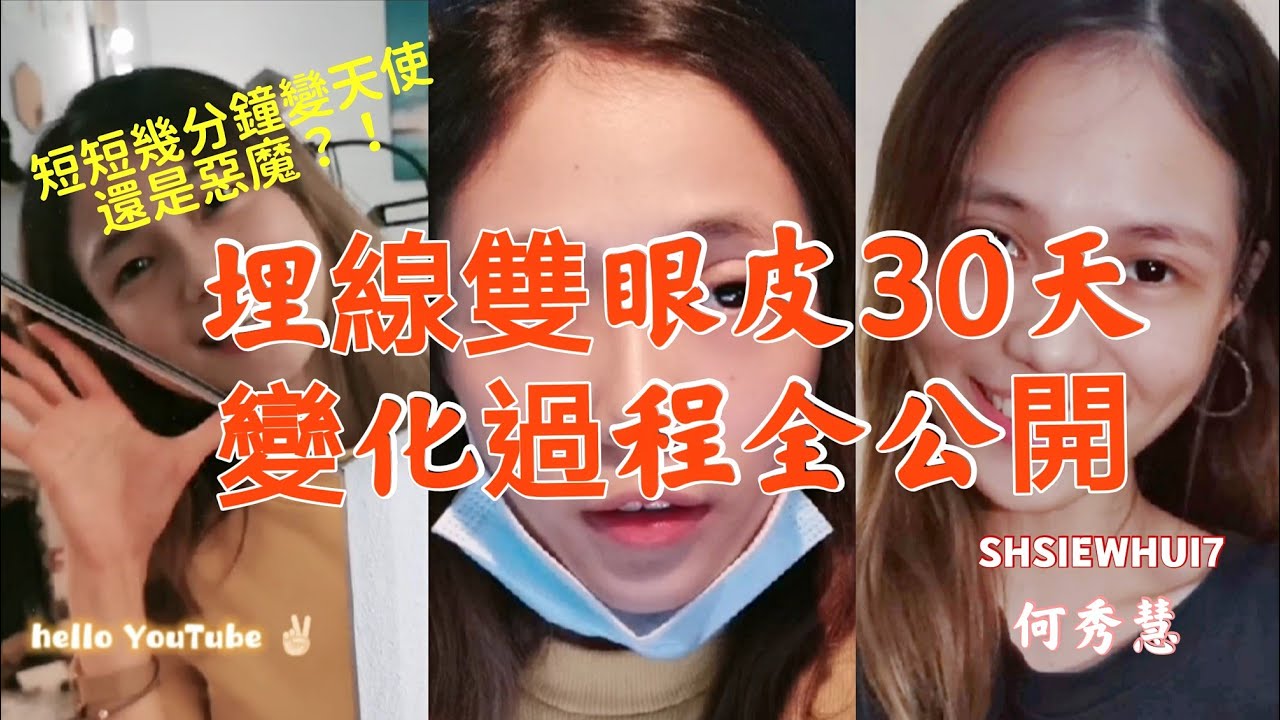 【Pretty】 👁️👁️埋線雙眼皮30天變化過程全公開 短短幾分鐘變天使還是惡魔⁉️ - shsiewhui7 何秀慧 ✨