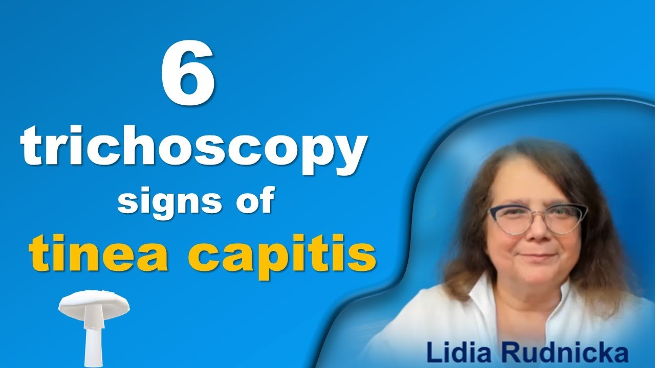 The 6 trichoscopy features of tinea capitis