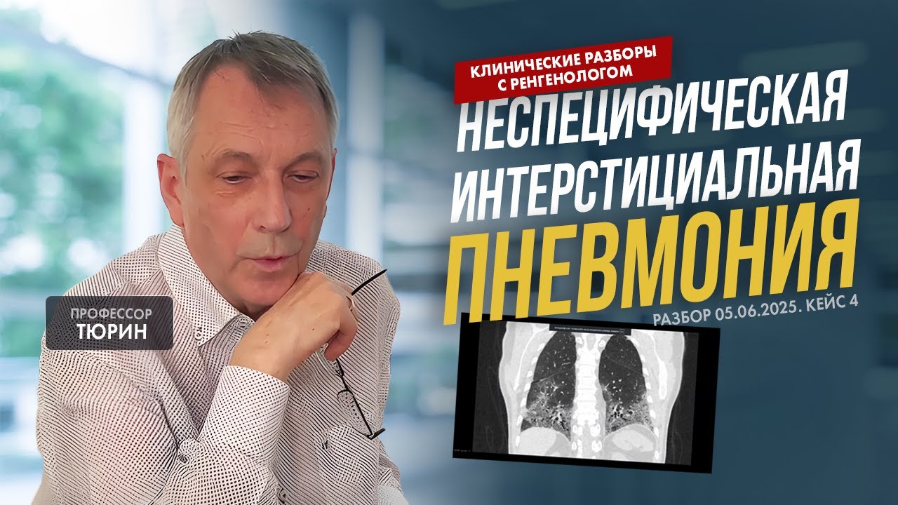 Клинические разборы с рентгенологом от 05.06. Кейс 4. Интерстициальная пневмония.