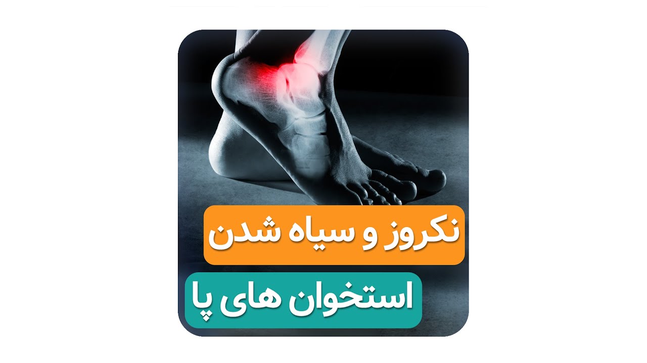 نکروز و سیاه شدن استخوان های پا (دکتر محمدرضا صادقی _ جراح ارتوپد )