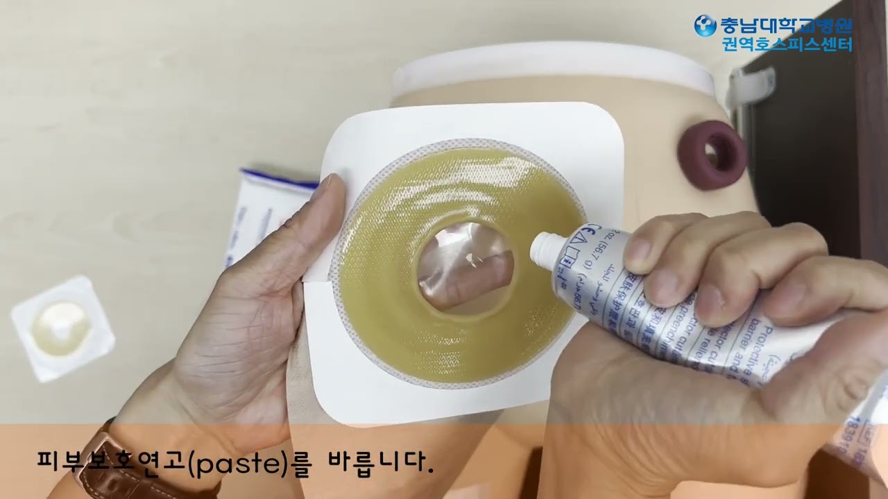 장루 교환(컨바텍)