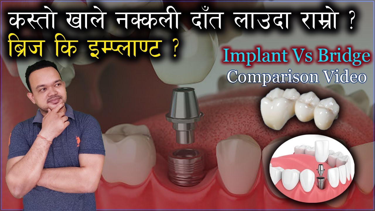 Bridge Vs Implant/फिक्स दातमा कुन राम्रो?/Missing tooth/ Fixed teeth / Doc Taj/ Zirconia Bridge