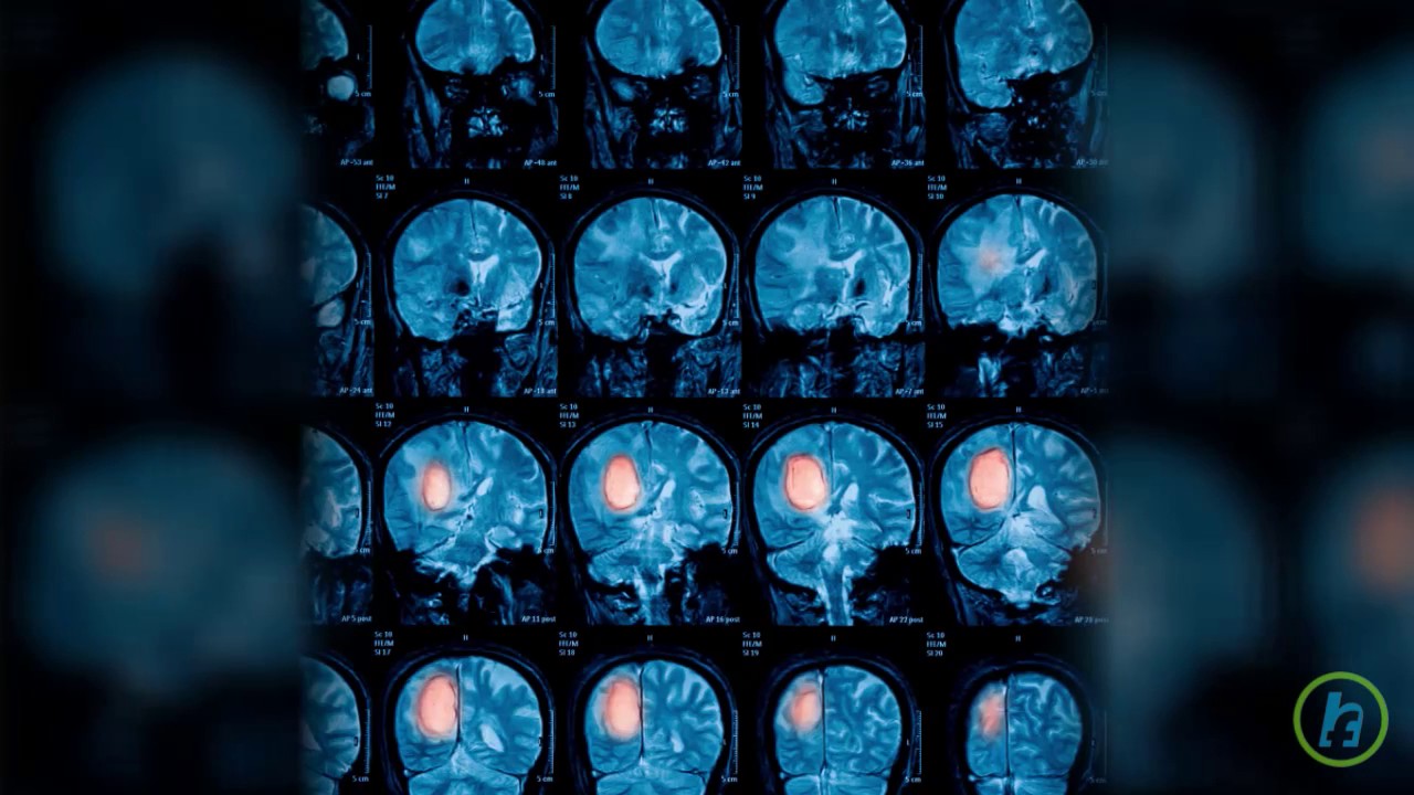 Brain Cancer Patients And Cannabis