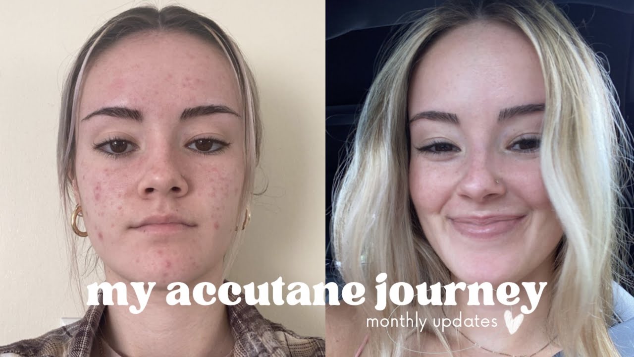 My Accutane Journey: 6 months on Accutane