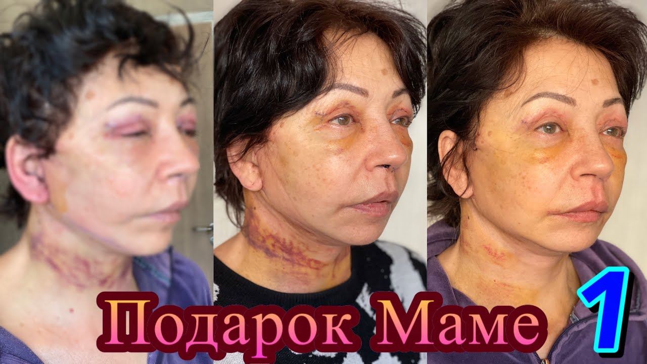 Сделали маме ПОДТЯЖКУ лица, Блефаро и Септо в Стамбуле 🎉