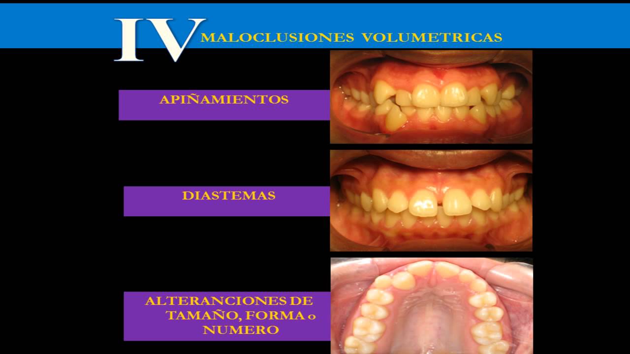 CLASIFICACION DE LAS MALOCLUSIONES PARTE 2