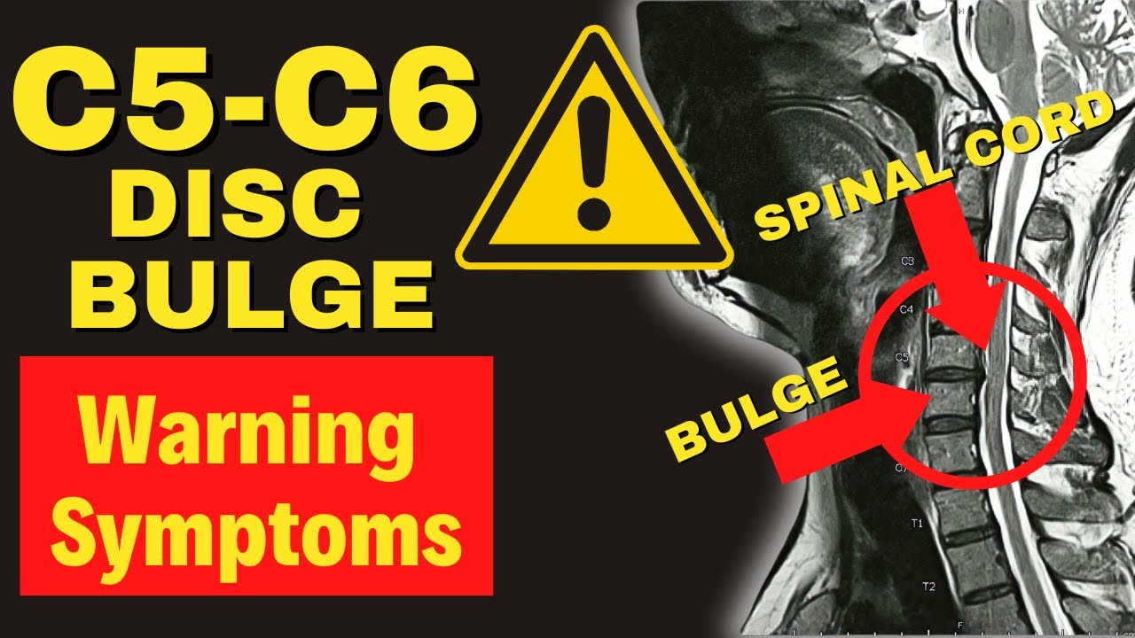 5 Warning Signs of Severe C5-C6 Disc Bulge - Dr. Walter Salubro Chiropractor in Vaughan