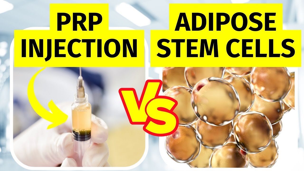 PRP Injection vs Adipose Stem Cell Therapy for Knee Arthritis