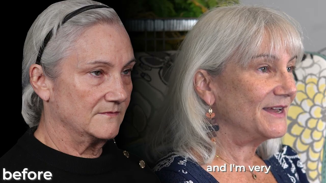 My FACELIFT Journey With Dr. Scott Holley - West Michigan Plastic Surgery