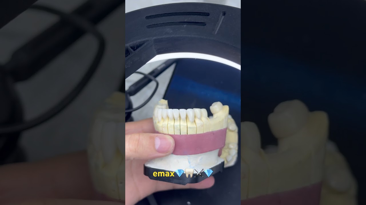 emax veneers #remix #dj #acoustic #dentist #zirconiajewellery #song #veneers