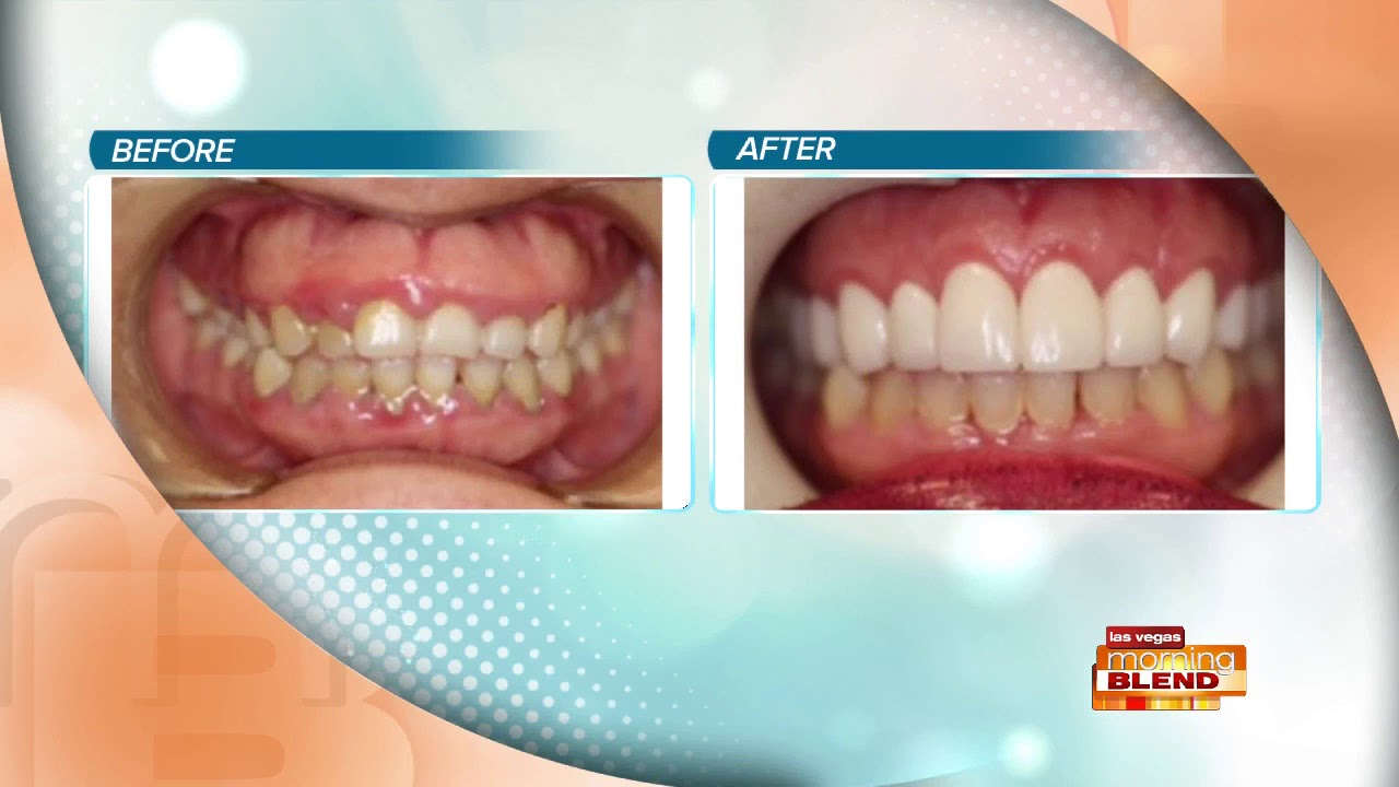 The New Way To Get A Perfect Smile