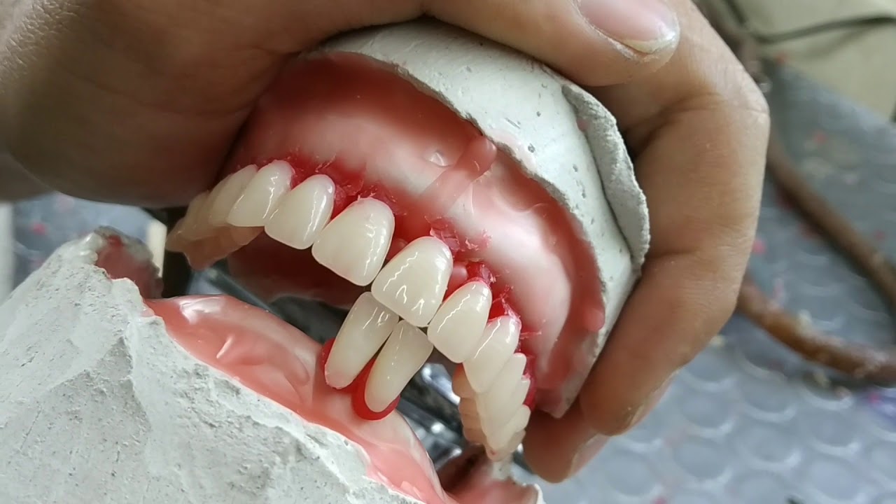 Enfilado dental inferior - prostodoncia - placa total