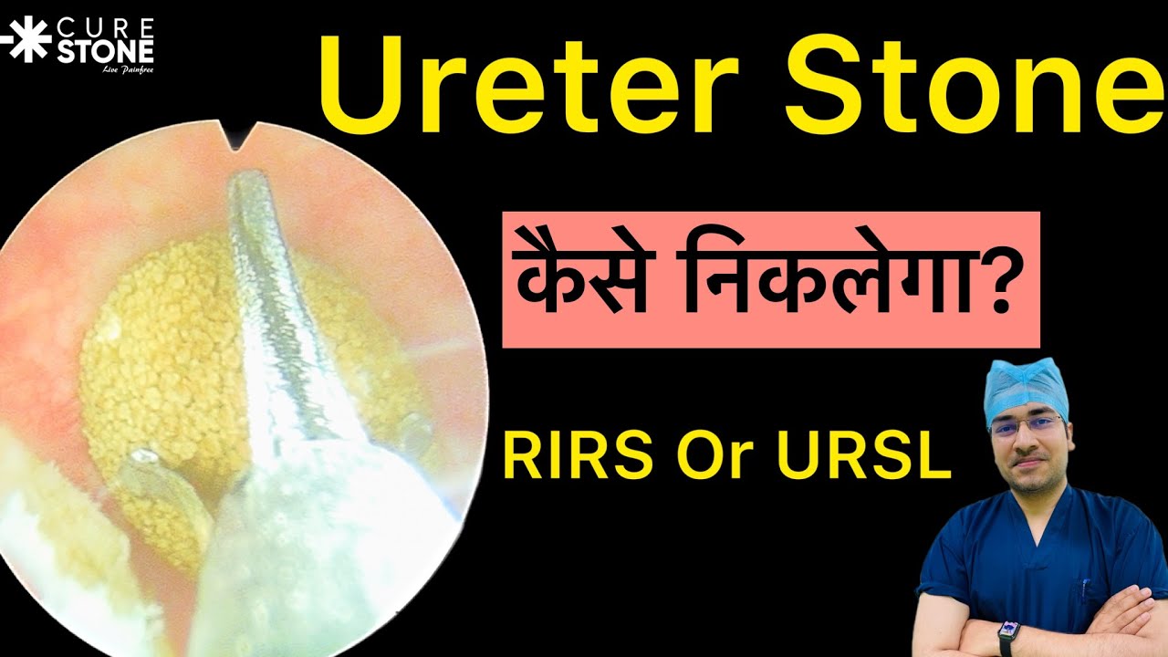 URSL vs RIRS Which one is better in ut stone removal? | पथरी हटाने में कौन सी  प्रक्रिया बेहतर है?