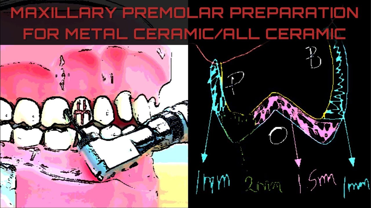 Dr VK's Dental Skool | MAXILLARY PREMOLAR PREPARATION |ALL CERAMIC | METAL CERAMIC (PFM) CROWN