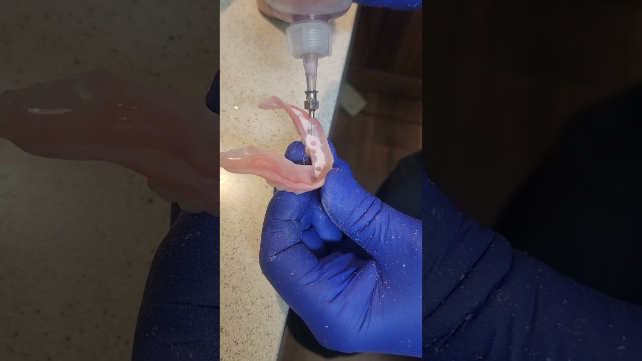 seating an overdenture with acrylic to attach to the remaining roots