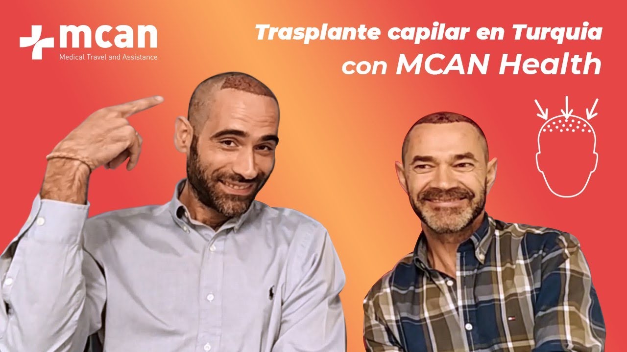 El trasplante capilar en Turquía de Sergio y Javier con MCAN Health