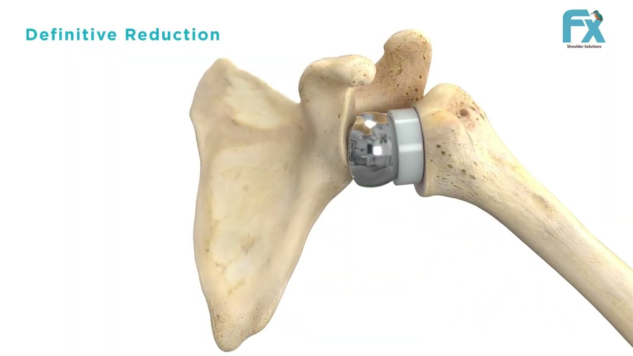 FX Shoulder System Animation | 135 Full Wedge Implant Visualization by Pulse 3D Media