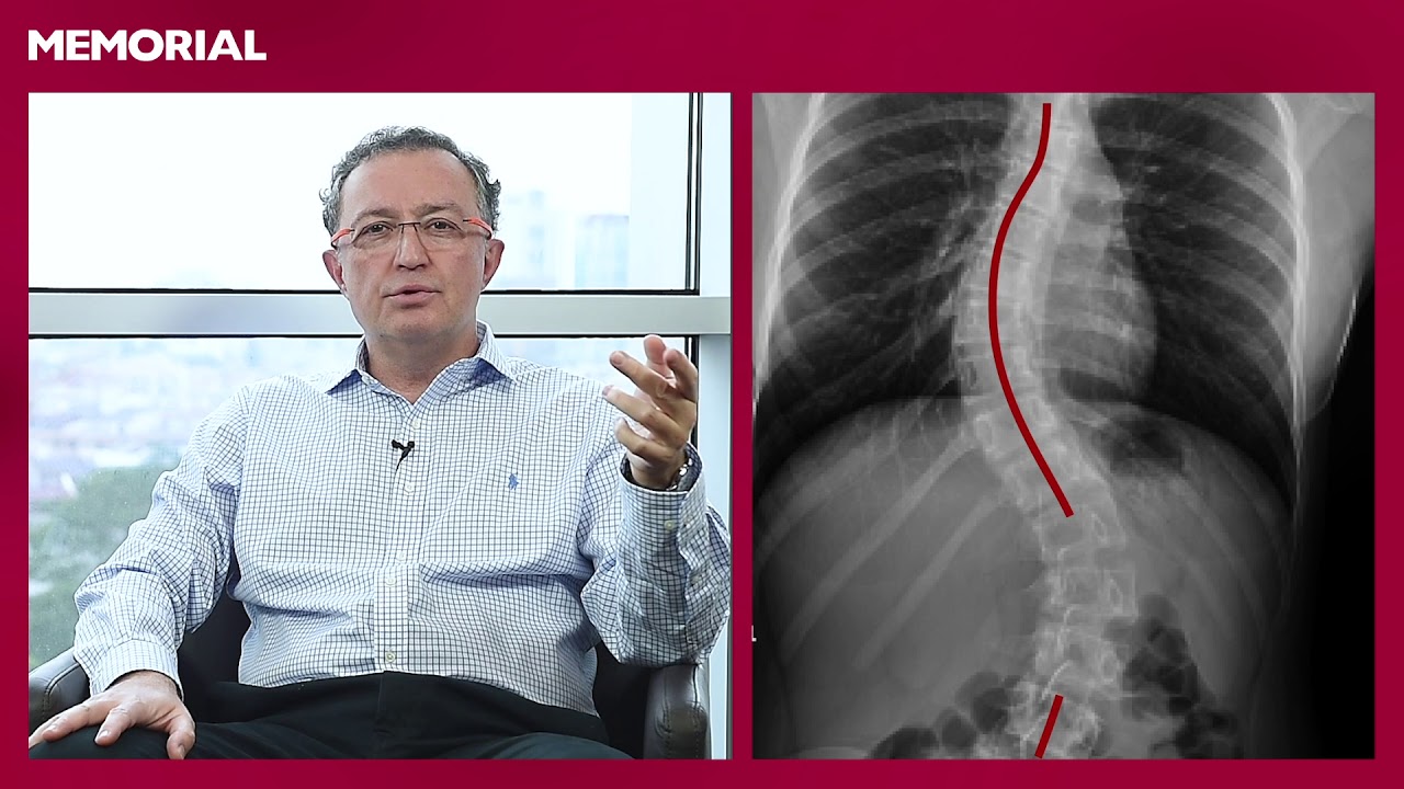Skolyoz nedir? - Prof. Dr. Emre Acaroğlu (Ortopedi ve Travmatoloji Uzmanı)