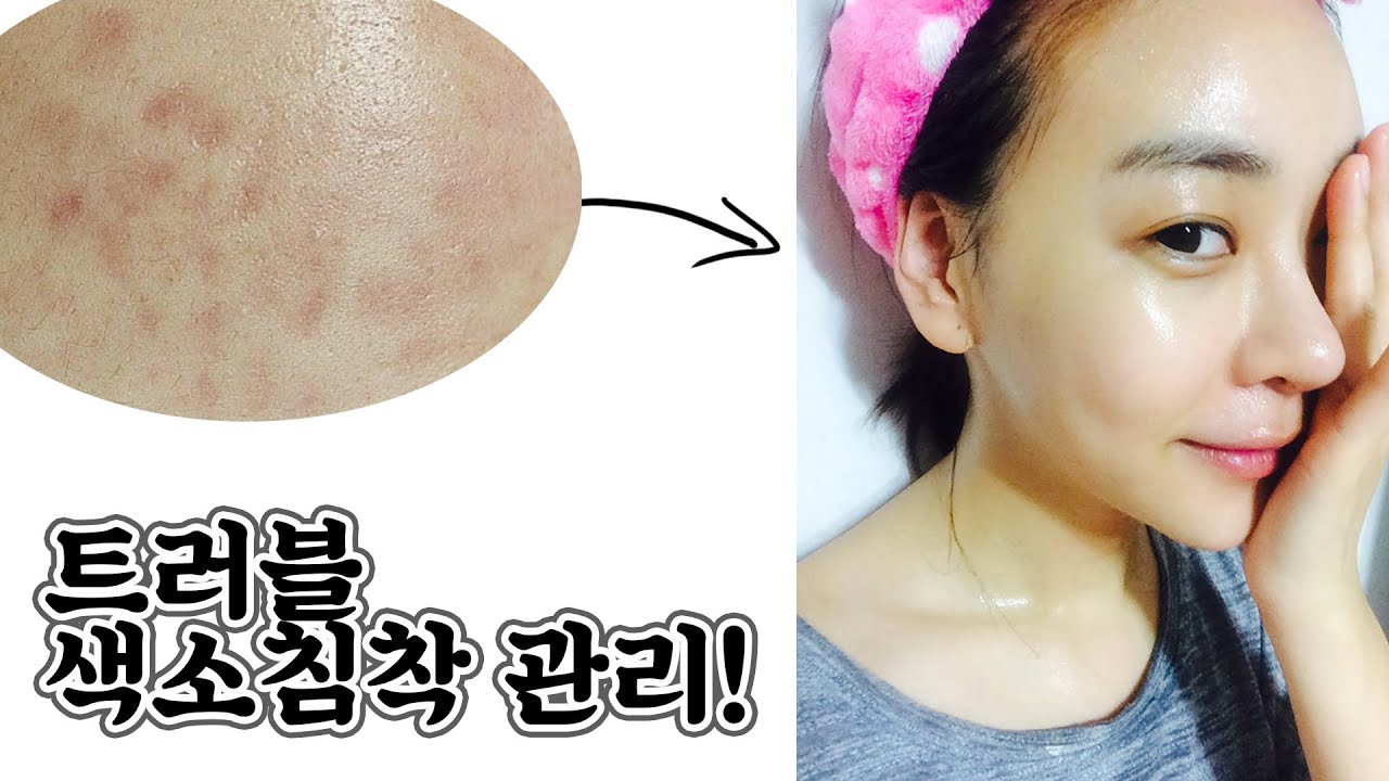 (ENG CC)단돈 6,900원으로 여드름 색소침착관리&기미,잡티가 사라지다! 연예인 꿀피부 홈케어!/흉터관리/ acne skin care