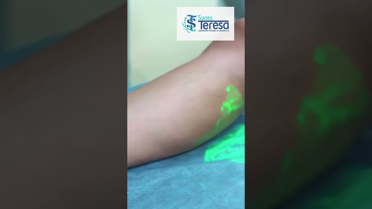 Tratamiento con yodo radioactivo