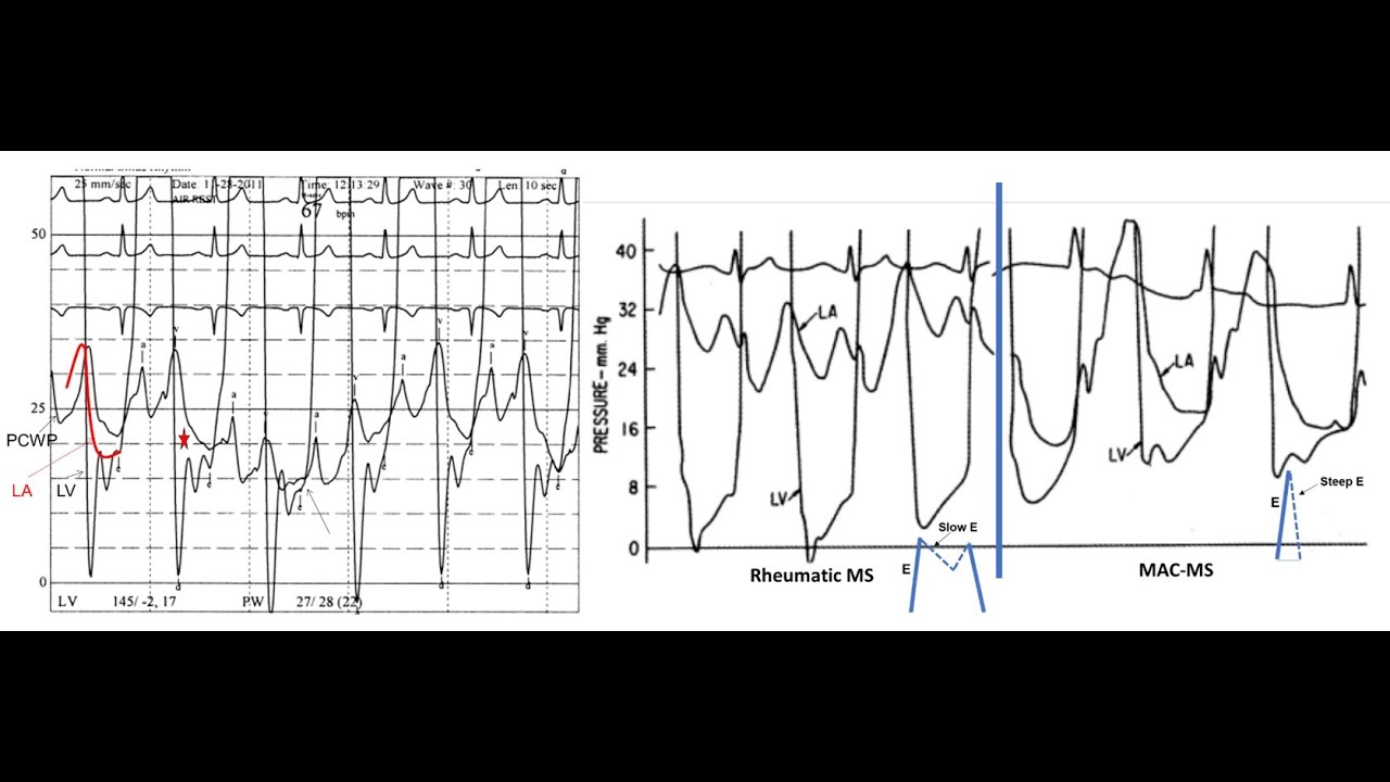Hemodynamics: valve area calculation, mitral stenosis and regurgitation - Elias Hanna, Univ of Iowa