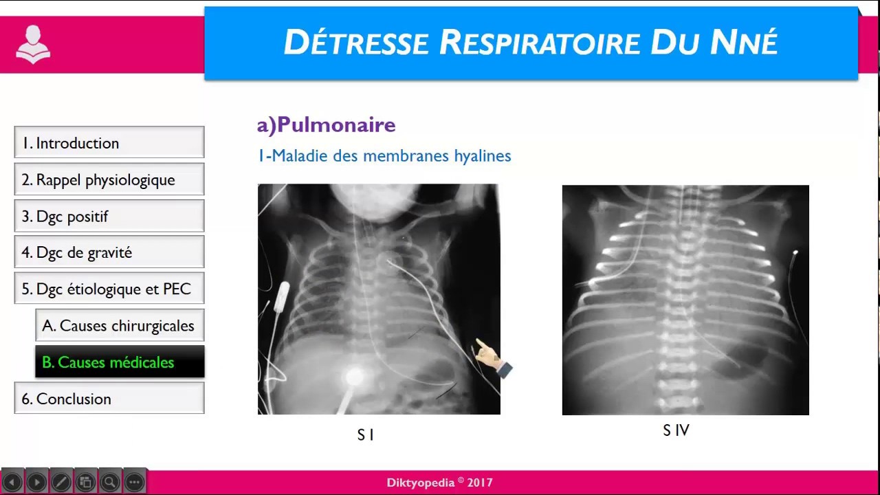Détresse respiratoire du NN
