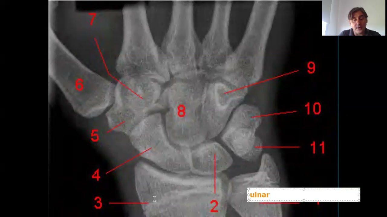 HUESOS DE LA MANO, CARPO, METACARPO, FALANGES. ANATOMIA, MIEMBRO SUPERIOR